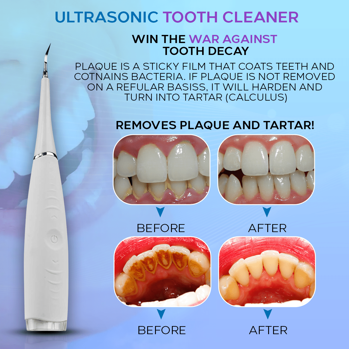 Ultrasonic Tooth Cleaner - Dental Hygiene Tool for Plaque Removal – Smile  Therapy